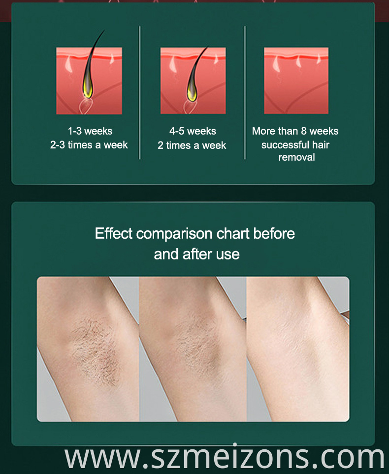 soprano ice laser hair removal brighton